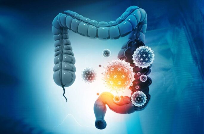 High-Fat Diet and Colorectal Cancer